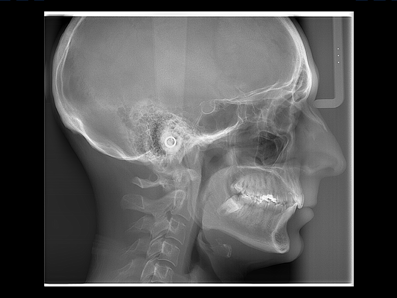 Telerradiografía Lateral